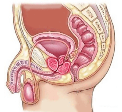 Causas de cistitis en hombres.